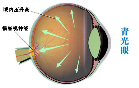 甘肅復(fù)雜疑難眼底病專科醫(yī)院 青光眼能嗎?
