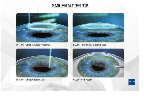 準(zhǔn)分子激光手術(shù)到底是怎么治 愈你的眼睛的？