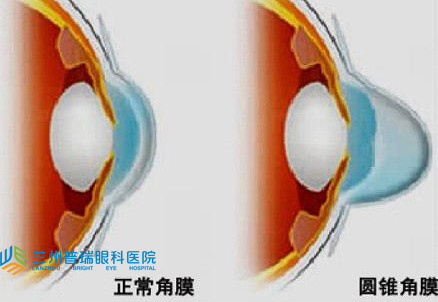 有圓錐角膜做不了近視手術(shù)怎么矯正視力