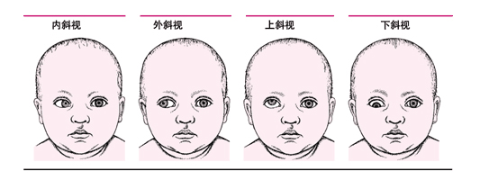 蘭州小兒眼睛斗雞眼哪里好?