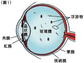 眼前有黑點飄，視物有些變形是什么眼病