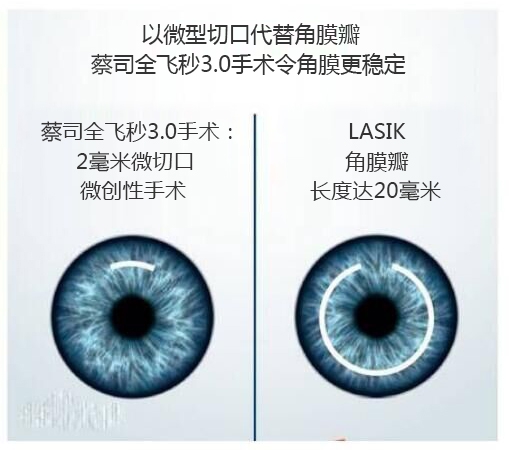 近視手術(shù)有哪幾種？你適合那種快看看