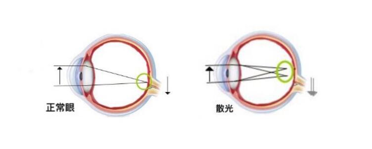 高度散光加近視可以做手術(shù)嗎？