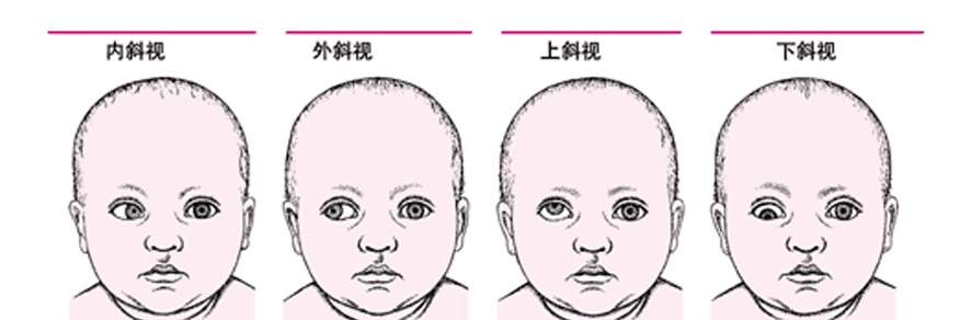 眼科醫(yī)生告訴寶媽寶爸：如何預防幼兒斜視